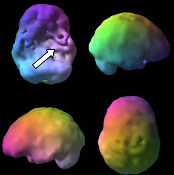 spect brain scan