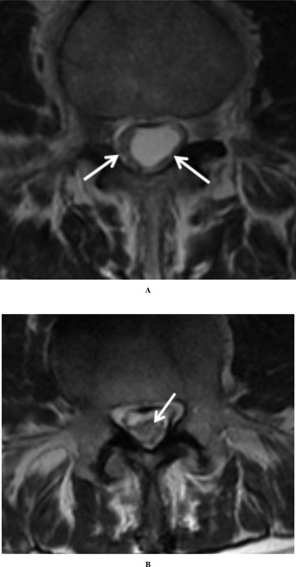 Cureus, Brainstem and Spinal Arachnoiditis Ossificans Associated With  Neurocysticercosis: A Case Report